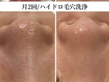 トリニエンス 南流山店/20代/ハイドロ毛穴洗浄