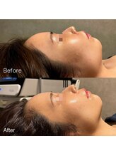 ユカリス(Yu.charis)/水光肌ミコステラ Before→After