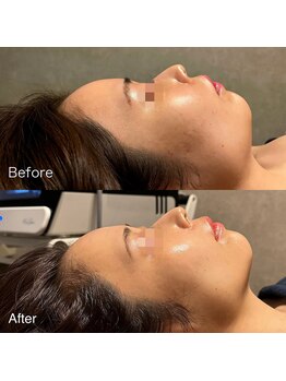 ユカリス(Yu.charis)/水光肌ミコステラ Before→After