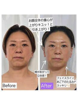 ハリ ヴァカンス(Hari Vacances)/電気鍼リフト