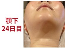 アミュレット 京都(amulette)/【顎下＋・頬】24日目