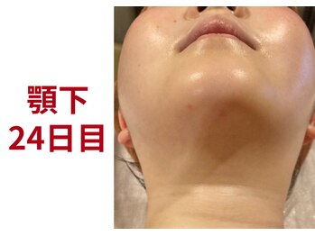 アミュレット 京都(amulette)/【顎下＋・頬】24日目