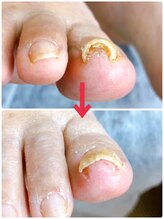 一宮巻き爪センター/巻き爪