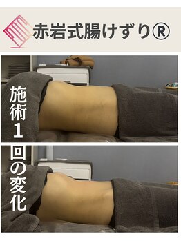 リア(Lia)/40代女性施術1回の効果