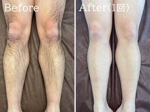 ココモンド(COCOMONDO)/顔脱毛/LED脱毛/エイジングケア