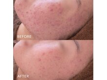 ポアレ(POARE)の雰囲気（ニキビは1年くらいで昔のように戻れる！諦めないでほしい！）