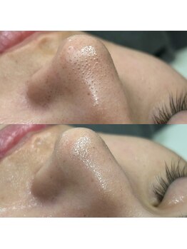 ラウラボ バイ ウォーヴォ(RAW LAB by UOVO)の写真/【エステ初心者でも◎】理容室併設のメンズ専門で毛穴洗浄体験！黒ずみやテカリ、いちご鼻が気になる方も！