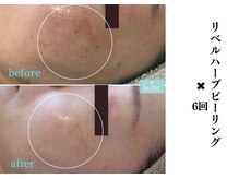 ブリエ 自由が丘(briller)/【リベルハーブピーリング】