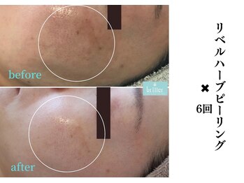 ブリエ 自由が丘(briller)/【リベルハーブピーリング】