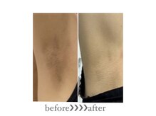 オークツリー(oak tree)/美白ワキ脱毛