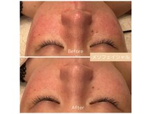 リュウズクリニカルスパ(Liu’s Clinical Spa)の雰囲気（【メソフェイシャル】お悩みに合わせた美容成分を導入します）