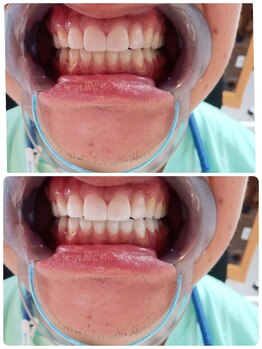 サロンTMP 熊本菊池/セルフホワイトニング