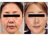 【30代からの極上ケア】光糸リフト+人幹細胞+顔筋リフトアップ¥25300⇒¥16000