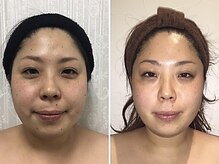 小顔フェイスラボ 鈴鹿店(小顔FaceLabo.)/◆小顔コルギ Before→After◆