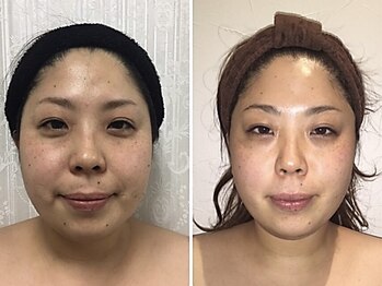 小顔フェイスラボ 鈴鹿店(小顔FaceLabo.)/◆小顔コルギ Before→After◆