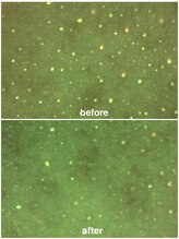 ベベ もりの里店(Be'be')/施術一回　皮脂詰まり変化♪