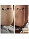 足裏角質ケア