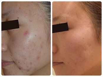 スイ 昭島店(Sui)/ホワイトスノーピール/シミ/美白