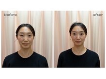 木下美容鍼灸整骨院の雰囲気（一人ひとりのお悩みに合わせた美容鍼を提供します）