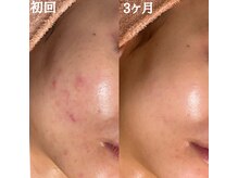 シャルナ(charna)の雰囲気（鏡を見るたび嬉しくなる。肌トラブルに悩まない透明美肌へ）