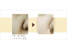 デジール/【頑固な毛穴の黒ずみ/テカリ】