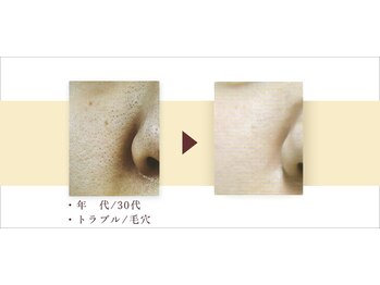 デジール/【頑固な毛穴の黒ずみ/テカリ】