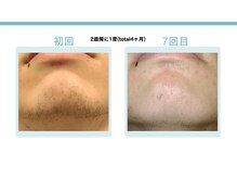 スターポルト(Star-Porte)/ヒゲ脱毛