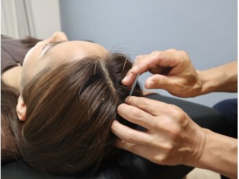 リコンディショニング 自由が丘(Reconditioning)/■鍼灸施術/頭■