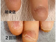 グレースレディ/少しずつ爪に厚みを