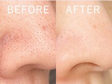 ビューティーリバース 横浜店/ハイドロスプラッシュ