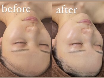 ナルシス(Narcissus)/ダウンタイムなしの肌質改善