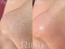 リツ(Ritsu)/角栓/黒ずみ/毛穴