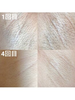 エシャーム(echarme)/脇脱毛