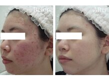 スマートポッシュ(Smart posh)/【ニキビケア】before→after