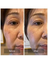 マインエム(mine.m)/刺さないリジュラン導入