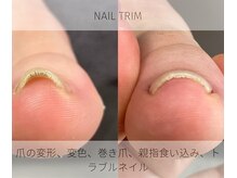 ロンディネ(Rondine)の雰囲気（巻き爪、爪のトラブルは放置しないでください。）