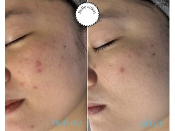 ベルサロン(Belle salon)/ニキビケアコース