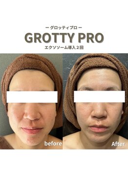 フルアナ(Hu ruana)/フェイシャルエステ