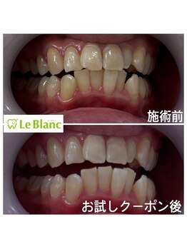 ルブラン 奈良店(Le Blanc)/お試しで白さ体感！