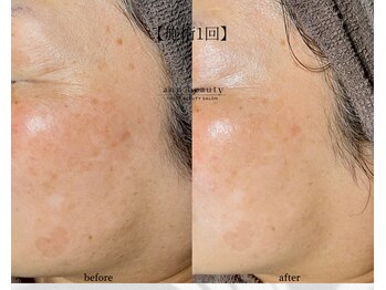 アン ビューティー(ann beauty)/施術1回【症例写真】