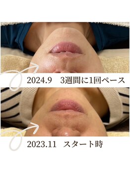 ビーボヌール(be-bonheur)/脱ポニョ! たるみフェイシャル