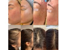 アベニール(AveniR)の雰囲気（大人気プロセルセラピーズ肌質改善＆スーピド育毛促進）
