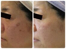 スイ 昭島店(Sui)/ホワイトスノーピール/シミ/美白