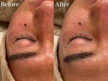 シャルム(Charme)/メンズフェイシャル♪1回の変化