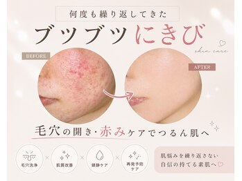 ハル(HARU.)の写真/【ぴったりメニュー発見☆】肌診断で選ぶ最適ケア★潤いと透明感のある、毛穴の目立ちにくい理想の美肌へ♪