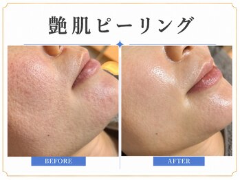 ビオエル(Bee'oele)の写真/くすみ・乾燥が気になる方へ。ふっくら艶肌ピーリングでハリ艶肌へ