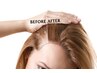 【育毛促進】頭皮の育毛促進施術です。頭皮プラズマシャワーと水光をします