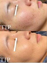 ミエル(miel)/【シミケア×ハーブピーリング】