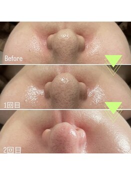 グレース(GRACE)/ラミピーリング