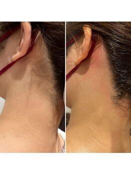 メローワックス 松本駅前店(MELLOW WAX)/うなじワックス脱毛